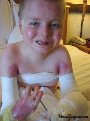 Nicky during a bandage change in June 2010