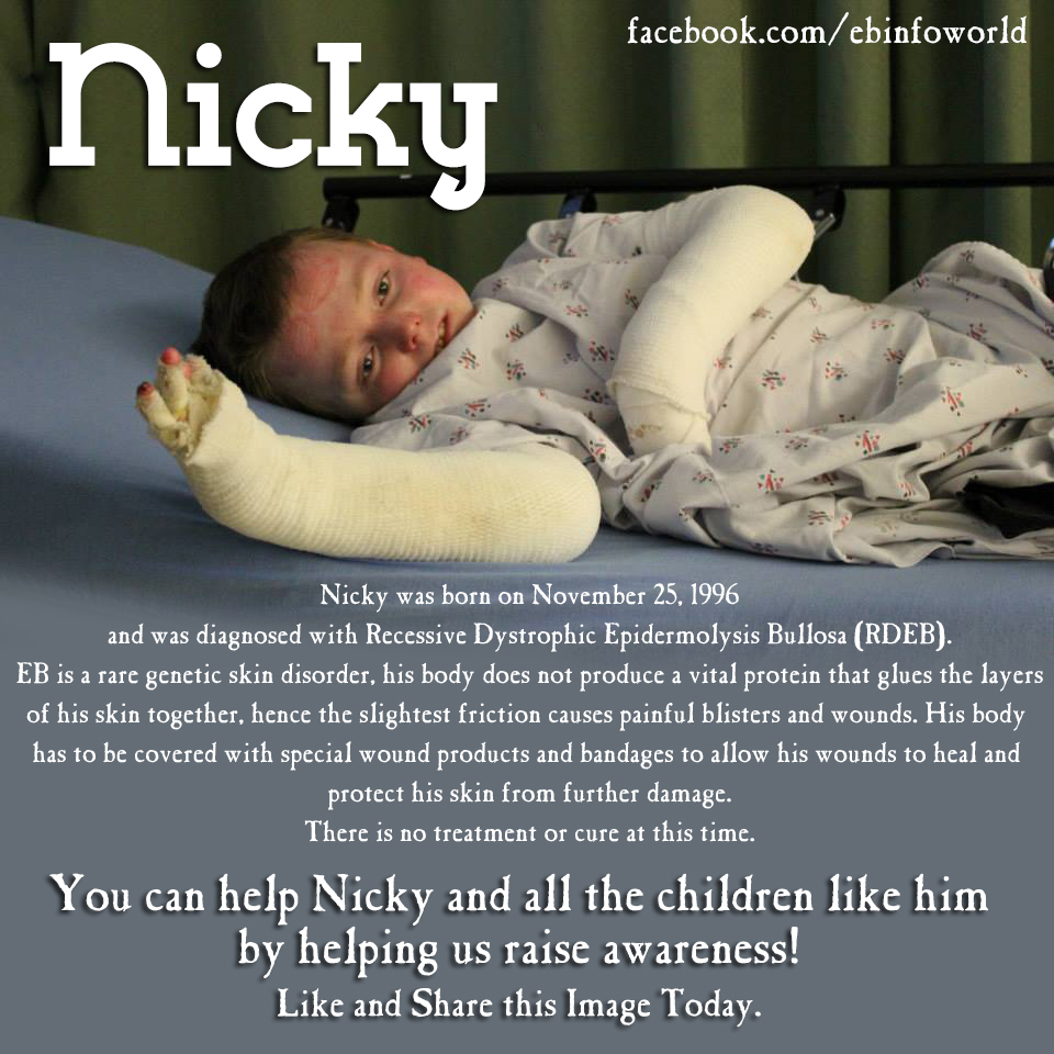 Help Nicky raise EB Awareness!